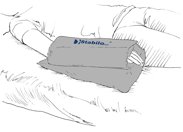 StabiloBed® Unterarmstabilisierung mit Sicherung – Bild 2